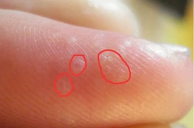 【擴散】一到夏天手上就長出的“小水泡”到底是什么？