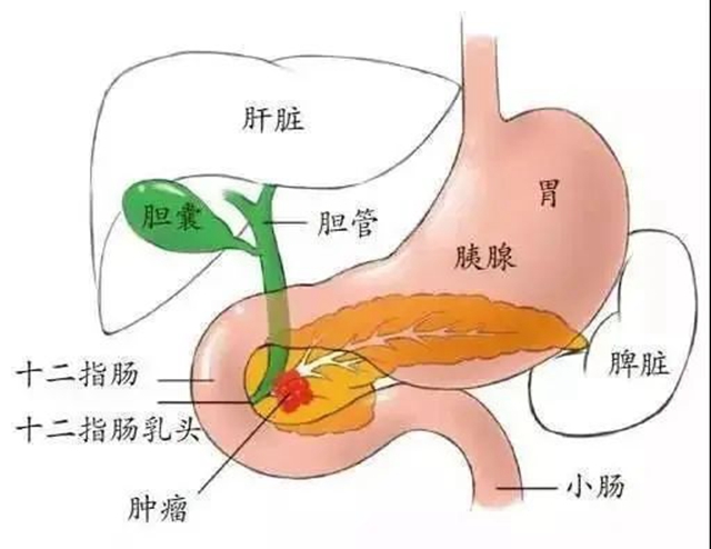【警惕】肚子痛了半個(gè)月，一查竟是癌......