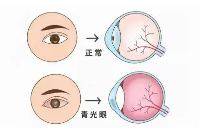 【開會啦】眼睛酸脹、看不清，小心這種致盲?。?文末學(xué)術(shù)研討別錯過）