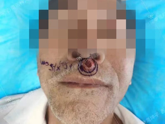 【圍觀(guān)】瀘州男子人中長(zhǎng)個(gè)“豆”，竟是癌……