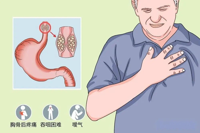 【警惕】吃東西哽起哽起的，癌！