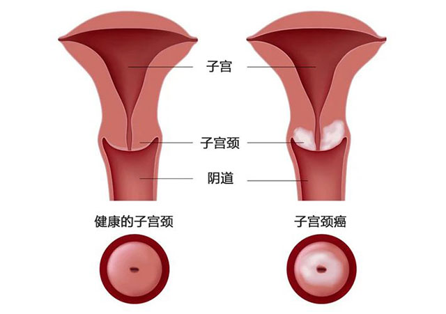 【警惕】24歲女子陰道流液，長菜花狀腫塊，確診宮頸癌