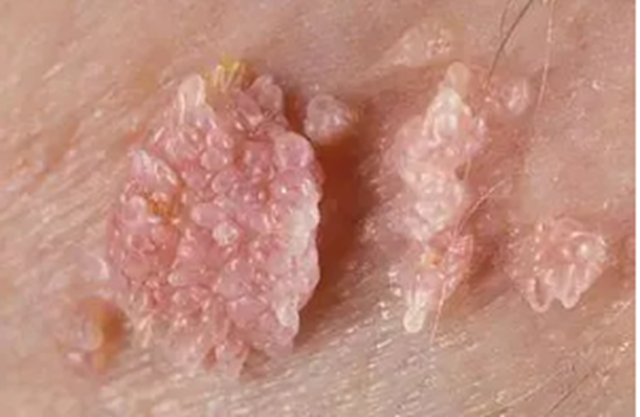 【警惕】00后情侶雙雙感染HPV，身上長(zhǎng)“花椰菜”......