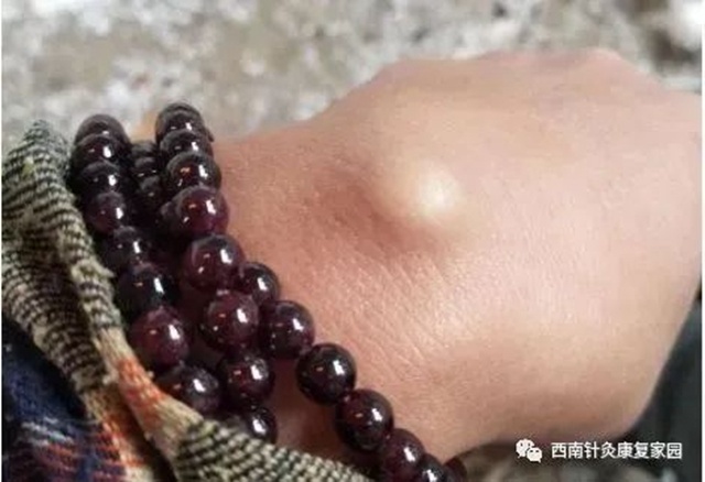 【圍觀】嬢嬢手腕上長(zhǎng)“腫瘤”？