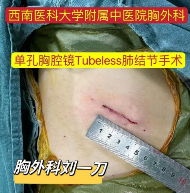 【厲害】肺結(jié)節(jié)手術(shù)，隔天就能出院
