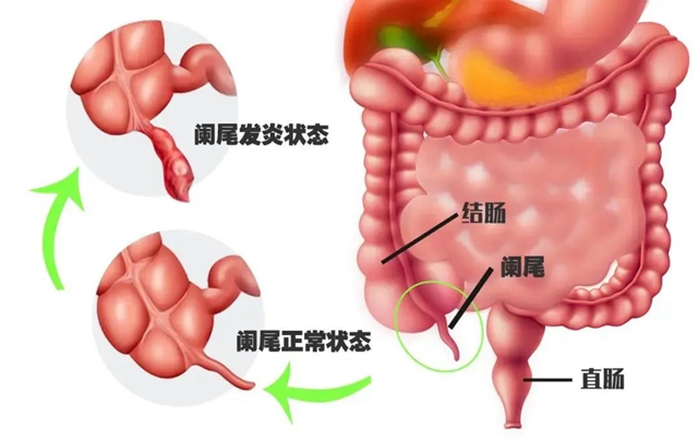 【警惕】男子吃西瓜不吐籽，掉進(jìn)闌尾，結(jié)果……