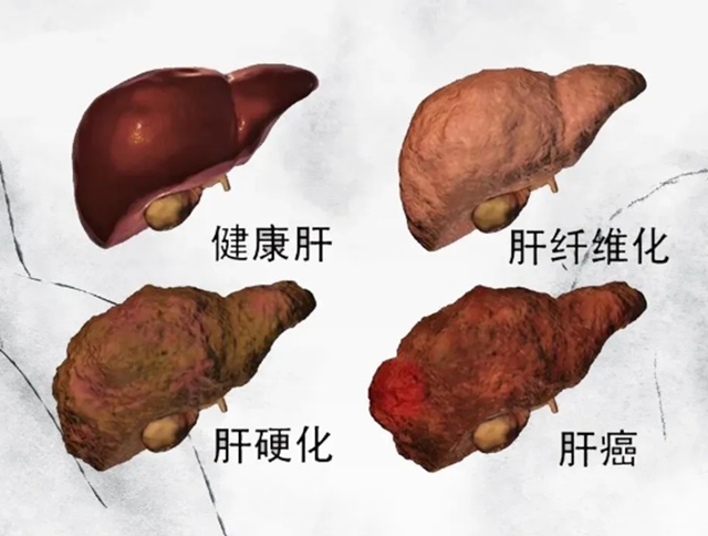 【技術】“介入+靶免”強強聯(lián)合，為肝癌患者帶來新“生機”！