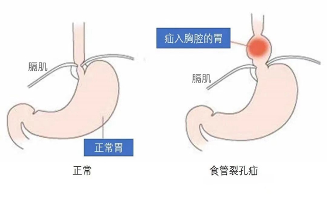 【圍觀】一吃就吐，男子胃部“竄”進了個大洞......