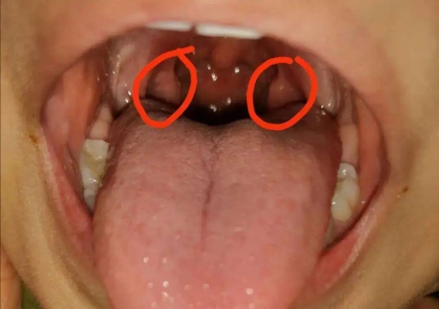 【注意】孩子出現(xiàn)這些癥狀，要當心！嚴重可影響發(fā)育