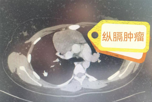 【警惕】16歲少女最終開(kāi)胸手術(shù)……這些情況要重視！