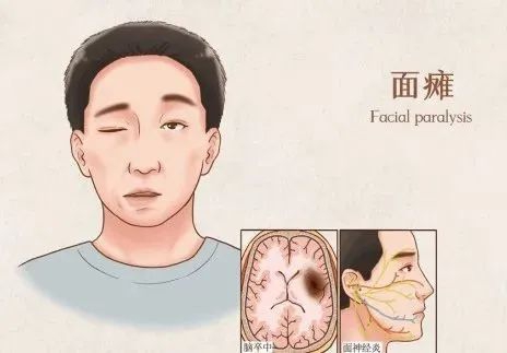 【科普】面癱，你怕了嗎？
