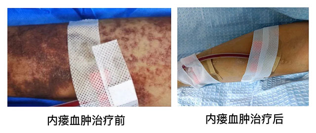 【病例分享】動(dòng)靜脈內(nèi)瘺出現(xiàn)皮下血腫怎么辦？