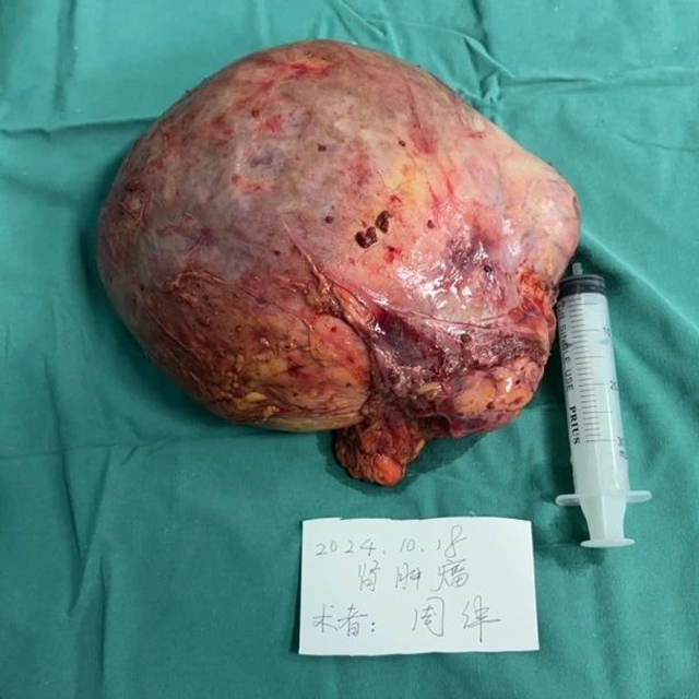 【技術(shù)】多科會(huì)戰(zhàn)，成功摘除右腎直徑20厘米巨大腫瘤！
