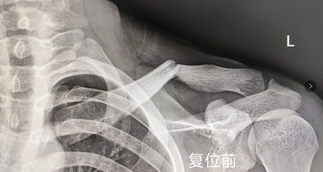 【圍觀】時隔一年，瀘州又一“爬樹哥”遭了