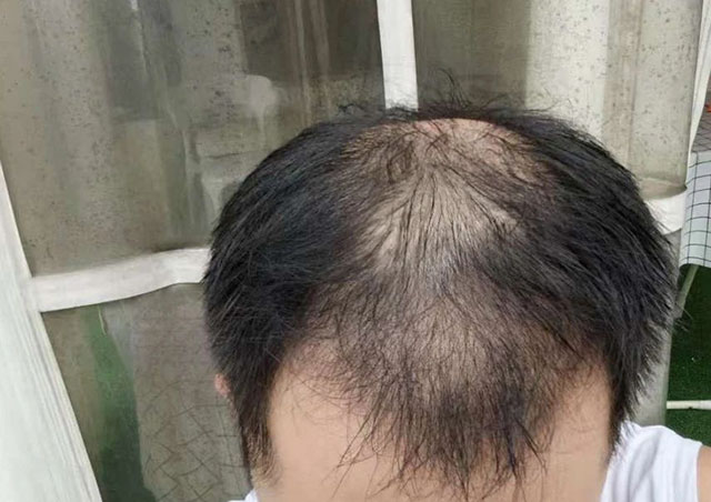 【現(xiàn)身說(shuō)法】瀘州小伙脫發(fā)，半個(gè)月禿頂，三個(gè)月逆襲……