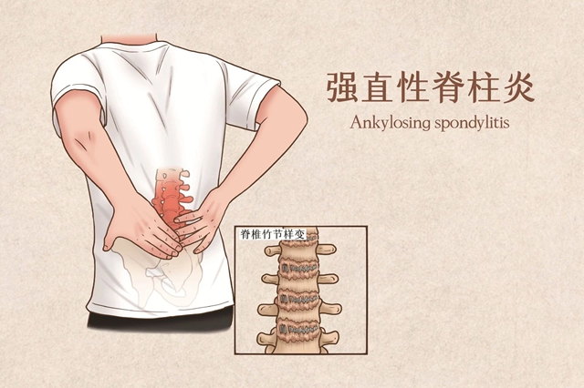 【圍觀】腰背部疼痛、僵硬……警惕！