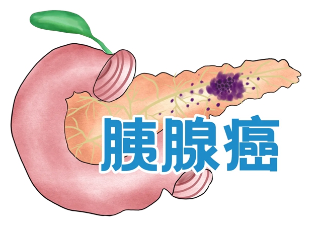 【發(fā)現(xiàn)即晚期】確診到去世僅2個(gè)月，癌中之王為什么這么“猛”？小心這些癥狀