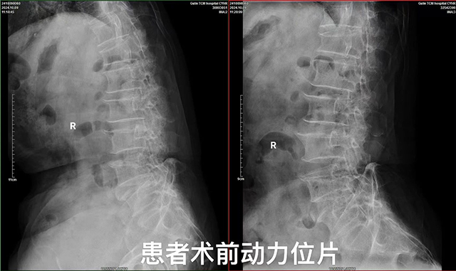 【專科技術(shù)】古藺縣中醫(yī)醫(yī)院椎間孔鏡髓核摘除術(shù)：精準(zhǔn)祛痛，脊柱微創(chuàng)新希望！