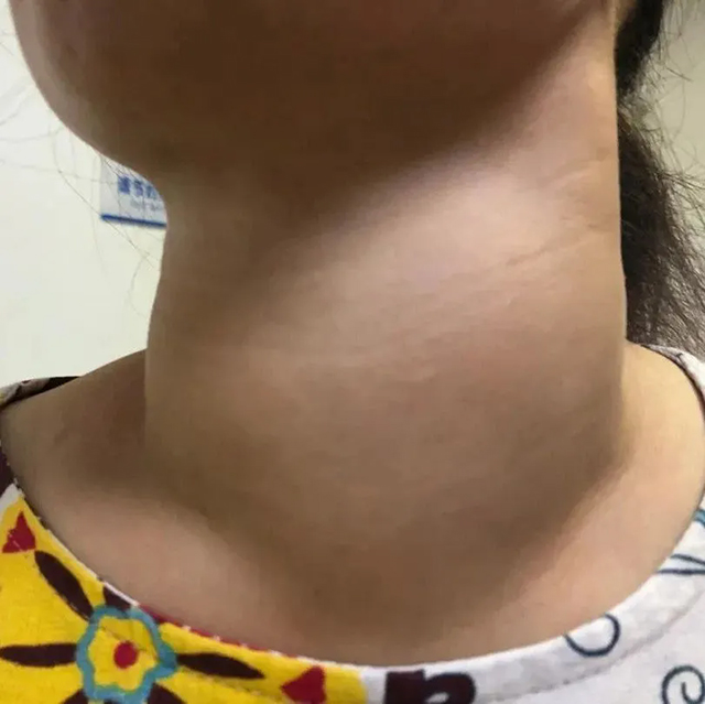 【圍觀】熬夜熬的是甲狀腺壽命！女主播總凌晨睡覺，脖子熬粗了