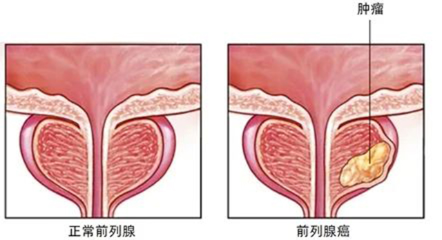 【提醒】父子三人先后確診同一種癌！醫(yī)生：早期無可識別癥狀