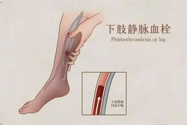 【關注】驚！置入濾器滯留男子體內(nèi)長達6年，險些……