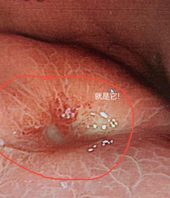 瀘州大姐腹痛竟查出胃癌！醫(yī)生：這樣做保命又保胃！