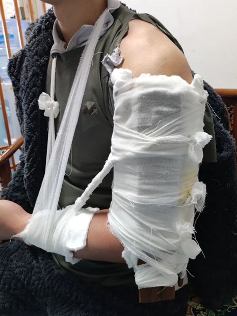 骨折6.jpg