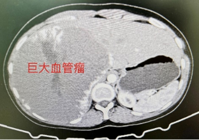 西南醫(yī)大中醫(yī)院完成建院以來最大血管瘤體腔鏡下切除手術(shù)