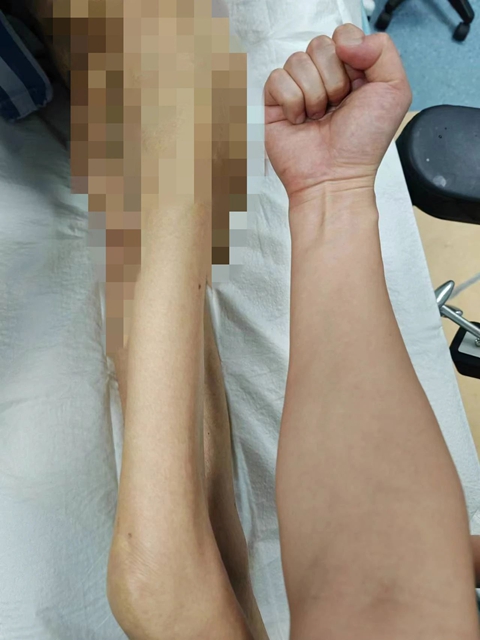 體重僅有60斤左右，瘦骨嶙峋的老人骨折了······