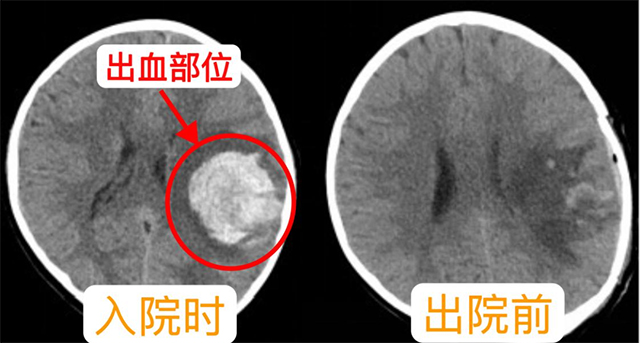 【病例分享】古藺中醫(yī)人用仁心妙術(shù)點(diǎn)亮九歲患兒的希望之光！