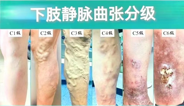 術(shù)治好瀘州阿姨20年的“蚯蚓腿”，創(chuàng)傷小、恢復(fù)快