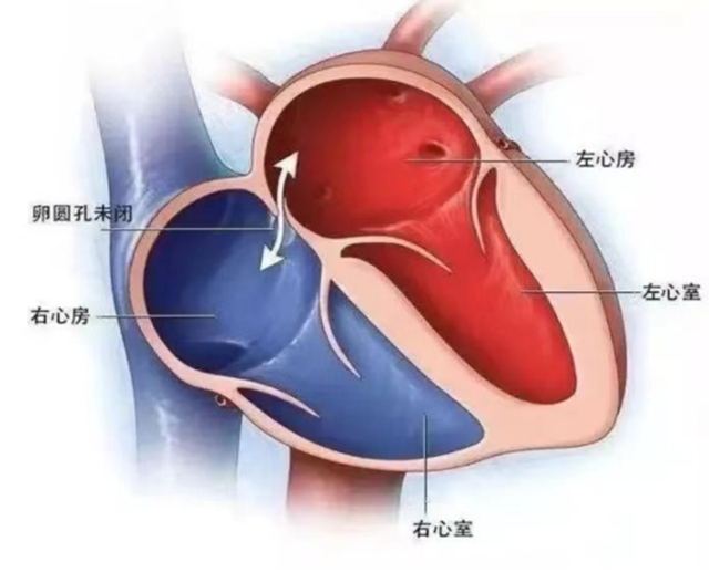 【擴散】20歲大學生長期偏頭痛，竟然是心臟出問題了