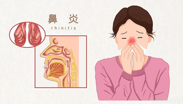 鼻炎老火？試試這個“鼻炎天下第一針”！