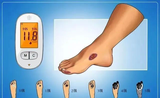 【警惕】一次小燙傷，差點(diǎn)被截肢！這個(gè)教訓(xùn)太深刻