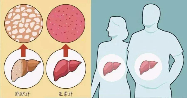 【關(guān)注】00后高中生也得脂肪肝？(圖7)