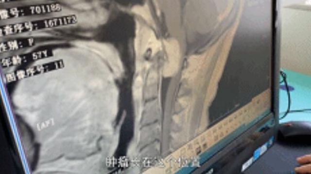 開始只是手指發(fā)麻，一查竟是顱內(nèi)腫瘤！差點(diǎn)就癱瘓……(圖3)