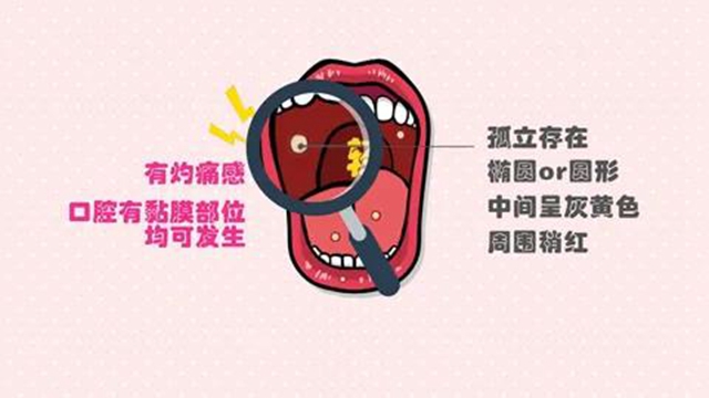 口腔潰瘍別總怪“上火”，3個tips拯救你！