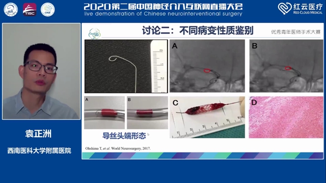 西南醫(yī)大附院腦卒中團隊袁正洲博士再次斬獲全國冠軍！(圖3)