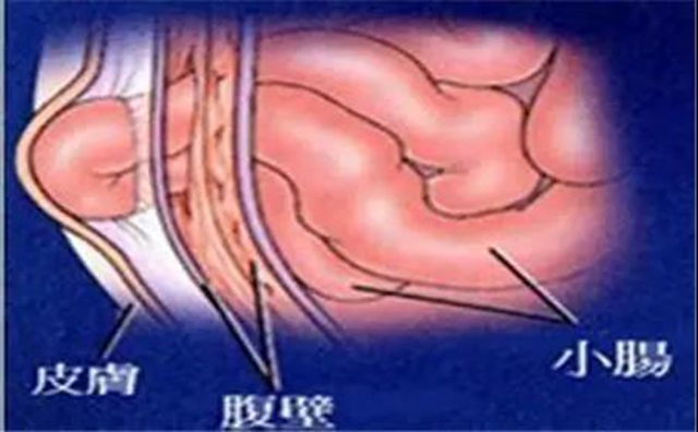 【厲害】指甲蓋大小手術(shù)切口治療疝氣！(圖1)