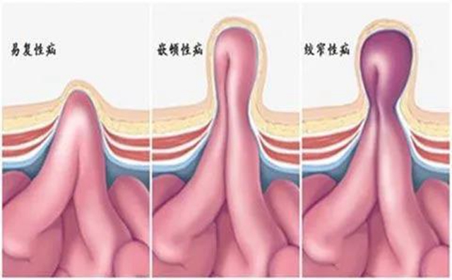 【厲害】指甲蓋大小手術(shù)切口治療疝氣！(圖8)