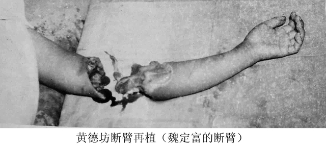 53年前，央廣向全世界播發(fā)：瀘州醫(yī)專附院為14歲少年成功接上斷臂！(圖4)