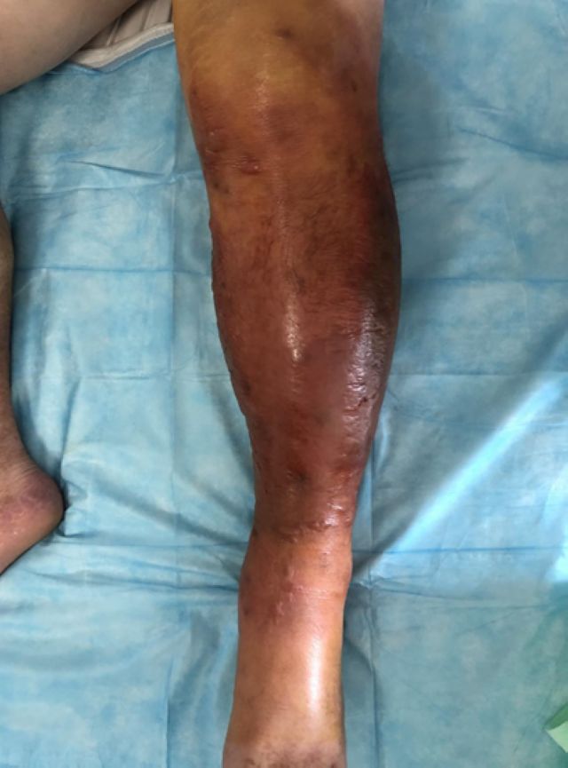 【圍觀】小腿腫成巨型“紅蘿卜”，瀘州男子中了什么毒？