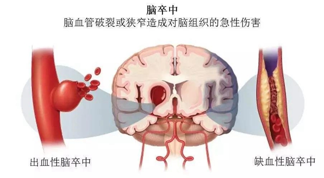 【擴(kuò)散】針眼大的口子，就能檢查腦血管??？(圖2)