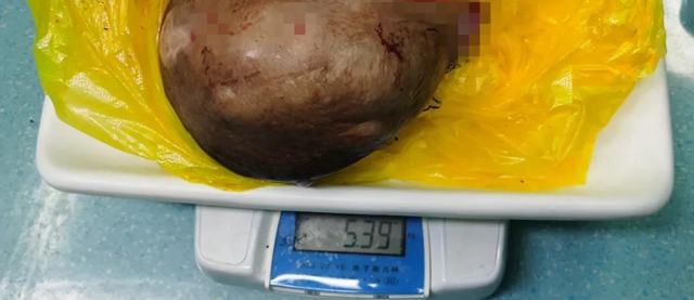 【關(guān)注】女子乳房長出巨大腫瘤，重達10斤？(圖5)
