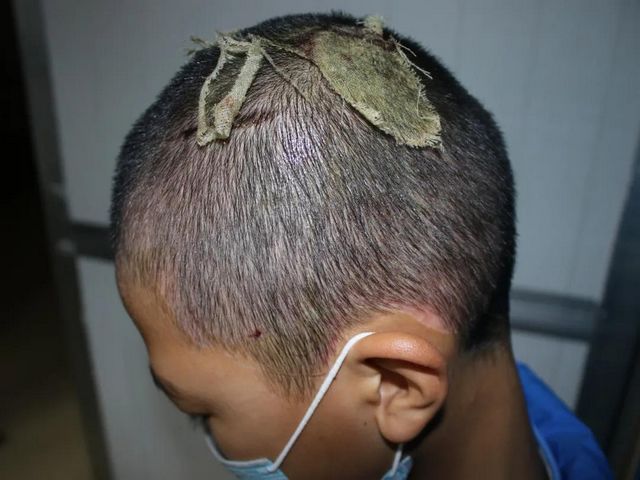 哥哥嚴(yán)重?zé)齻?歲雙胞胎弟弟捐頭部皮膚不叫一聲疼！