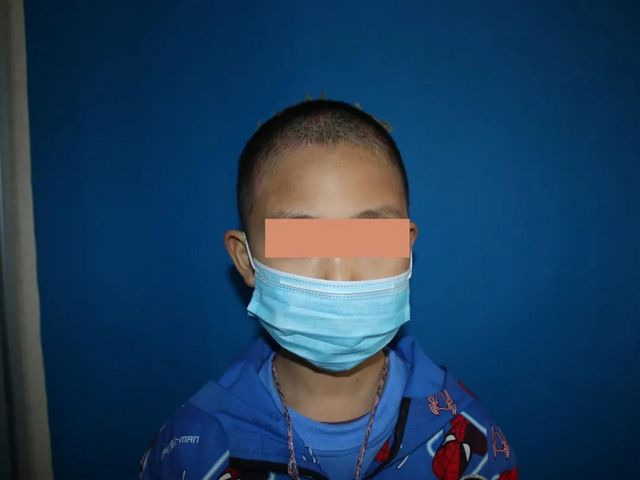哥哥嚴重燒傷，7歲雙胞胎弟弟捐頭部皮膚不叫一聲疼！(圖7)