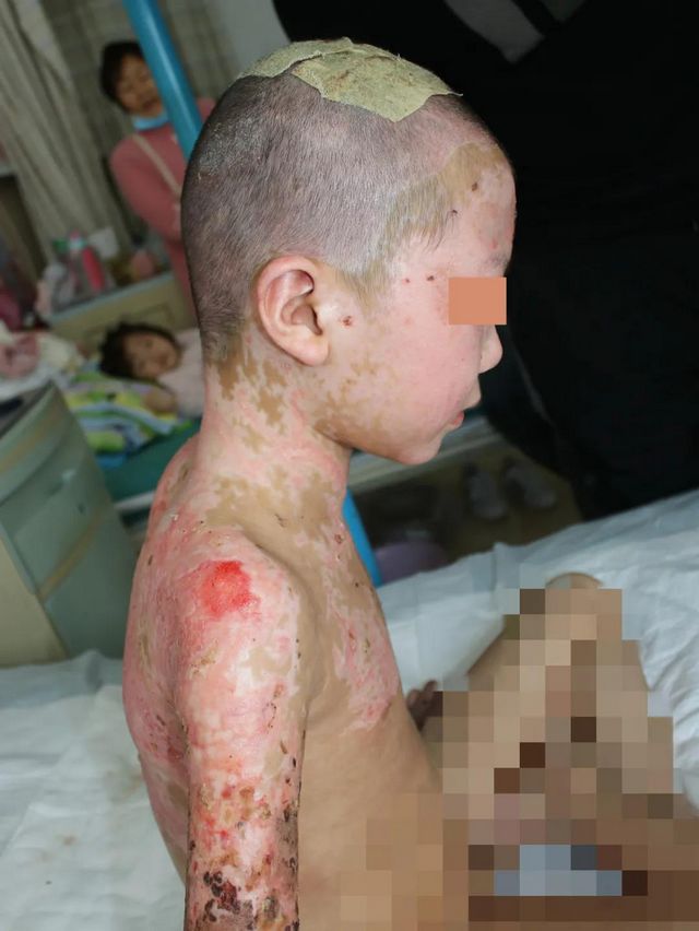 哥哥嚴重燒傷，7歲雙胞胎弟弟捐頭部皮膚不叫一聲疼！(圖4)