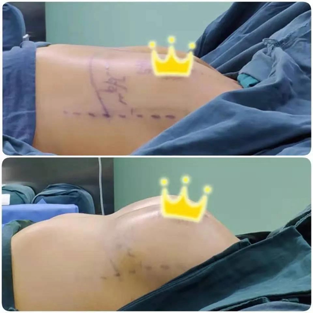 【圍觀】帥氣男醫(yī)生出手！30歲辣媽重回C罩杯？(圖6)