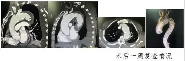 瀘州市人民醫(yī)院首次獨立成功完成復(fù)雜胸腹主動脈夾層血管腔內(nèi)修復(fù)術(shù)(圖3)