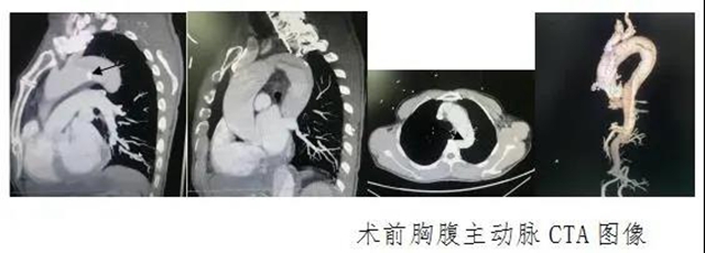 瀘州市人民醫(yī)院首次獨立成功完成復(fù)雜胸腹主動脈夾層血管腔內(nèi)修復(fù)術(shù)(圖2)